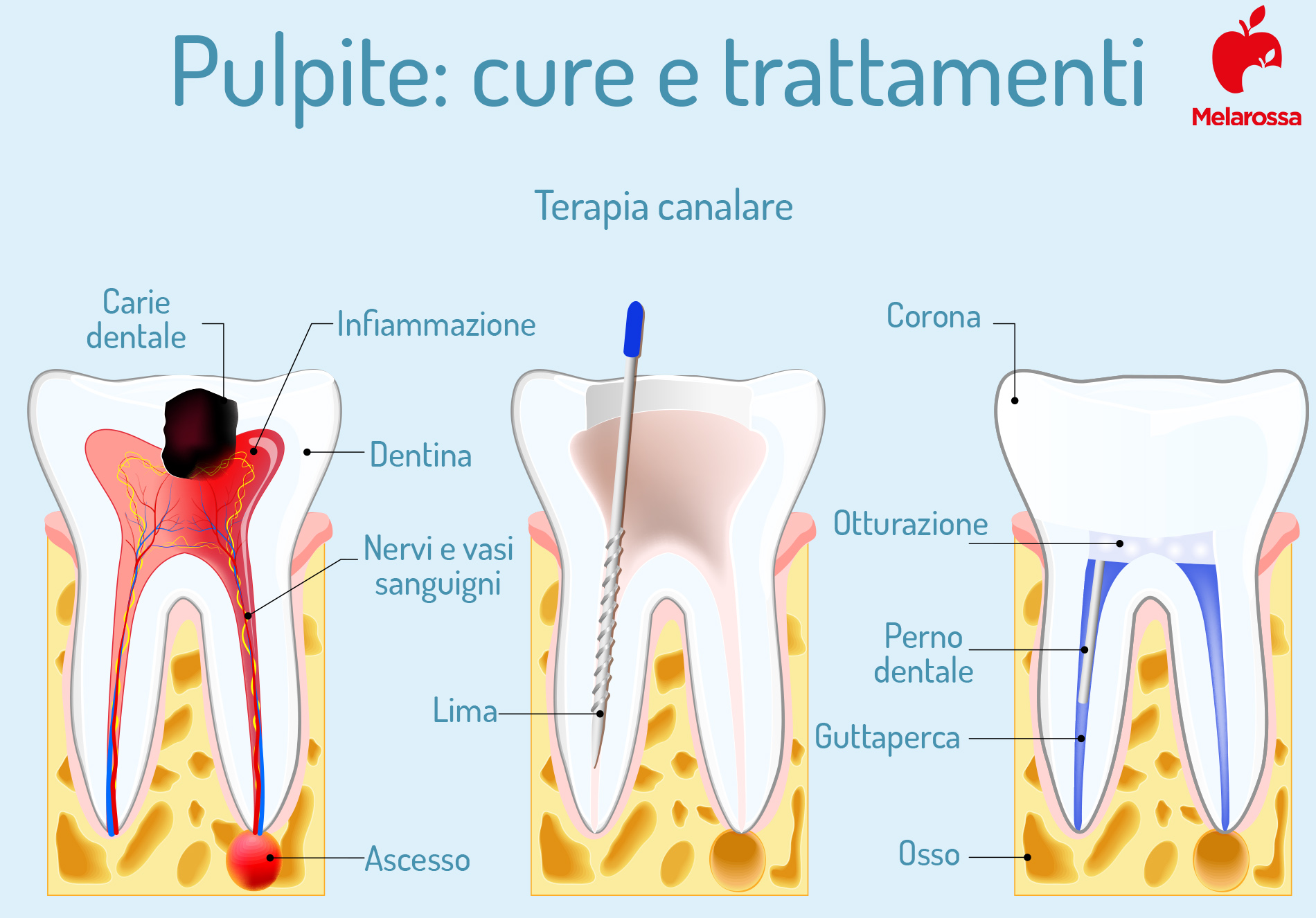 Pulpite dentale: terapia canalare