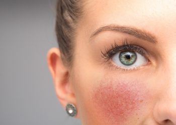 rosacea: cos'è, cause, sintomi e cure