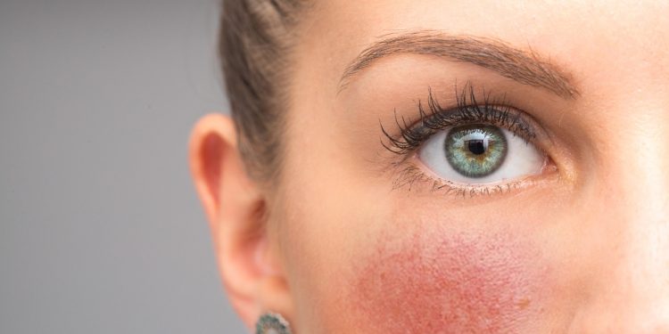 rosacea: cos'è, cause, sintomi e cure