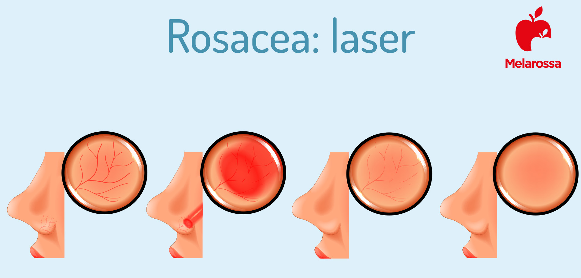 rosacea: cure con laser