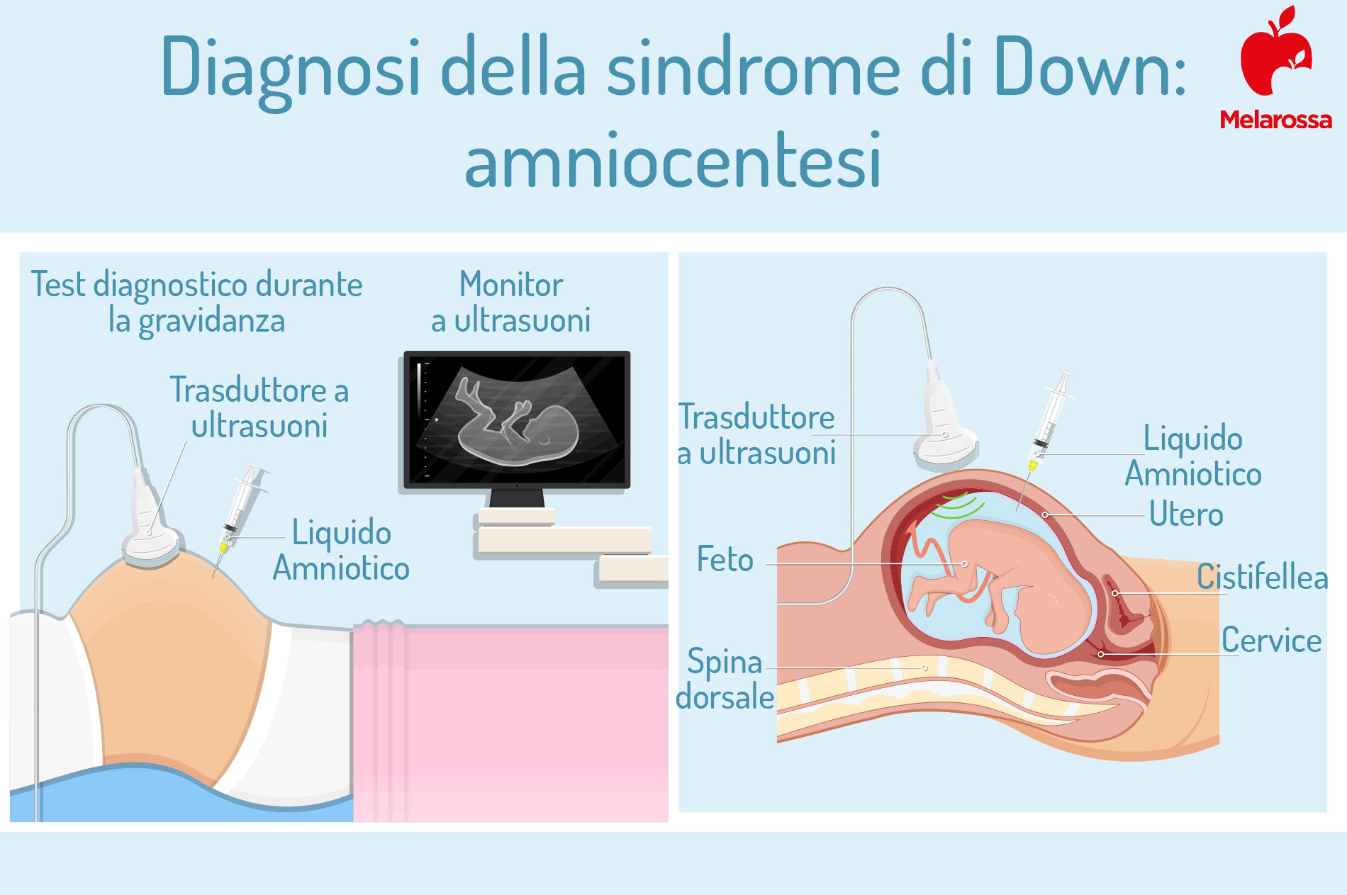 sindrome di Down: diagnosi 