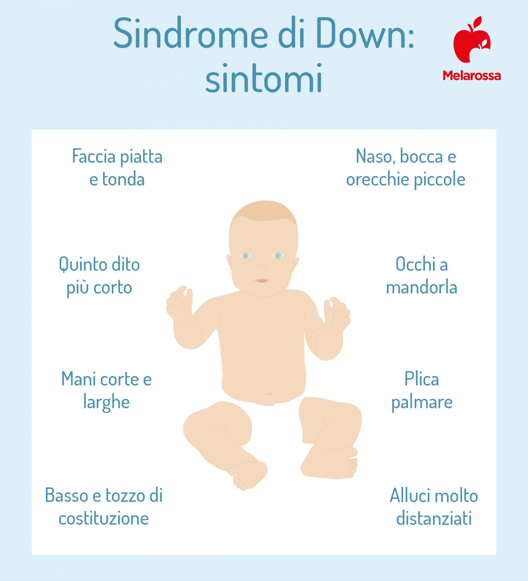 sindrome di Down: sintomi 
