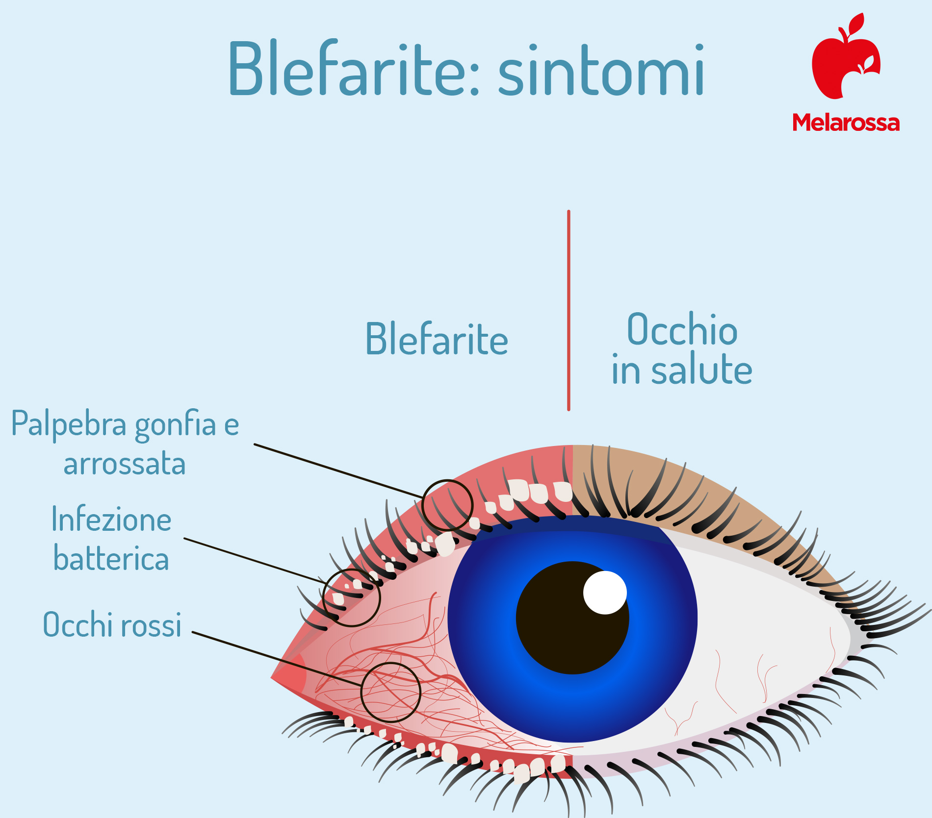 blefarite: sintomi 