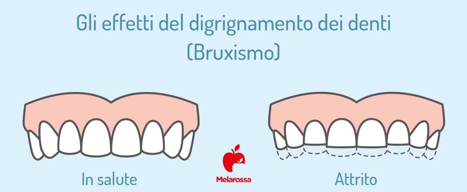 denti-bruxismo-infografica 
