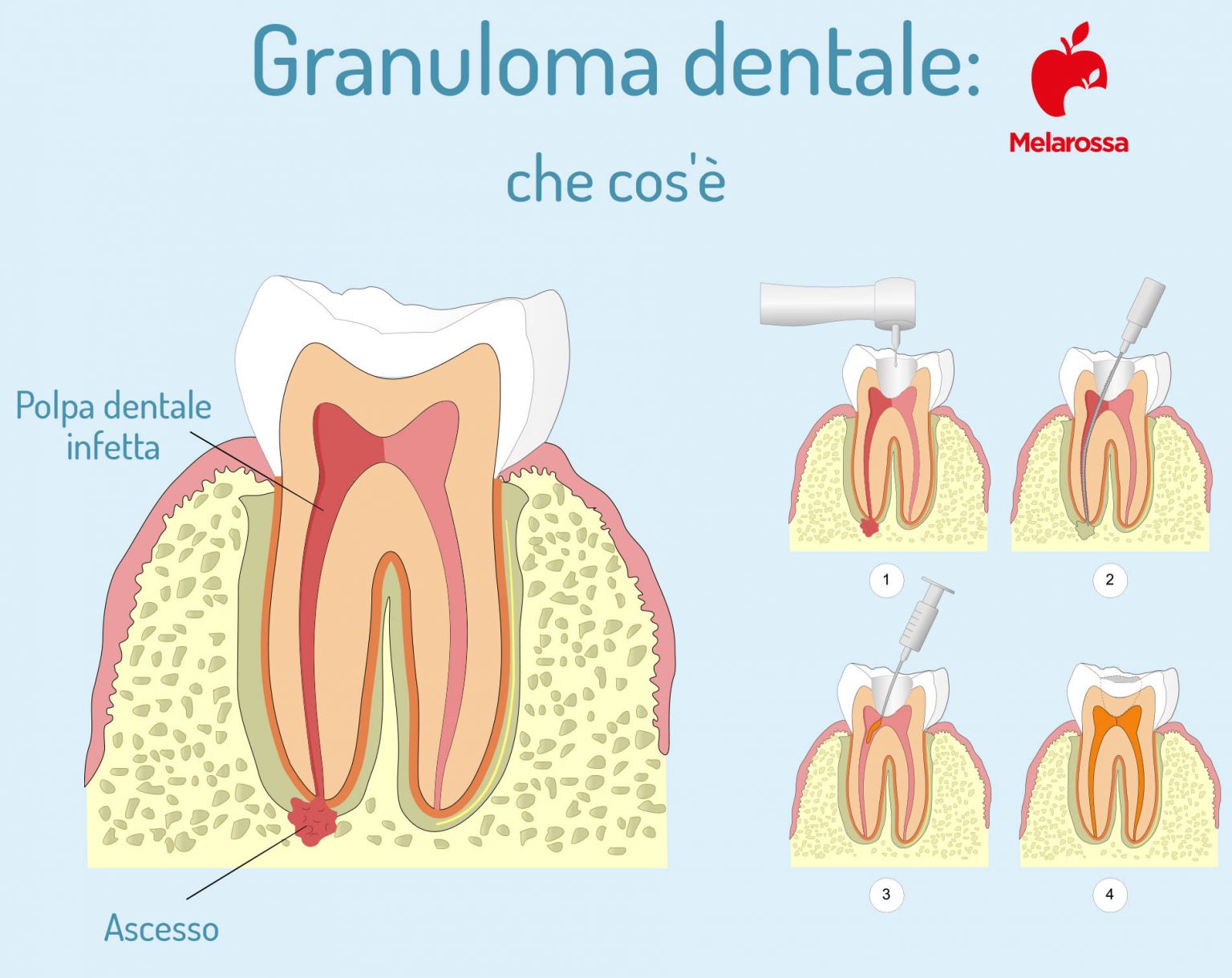 denti patologia: granuloma dentale 
