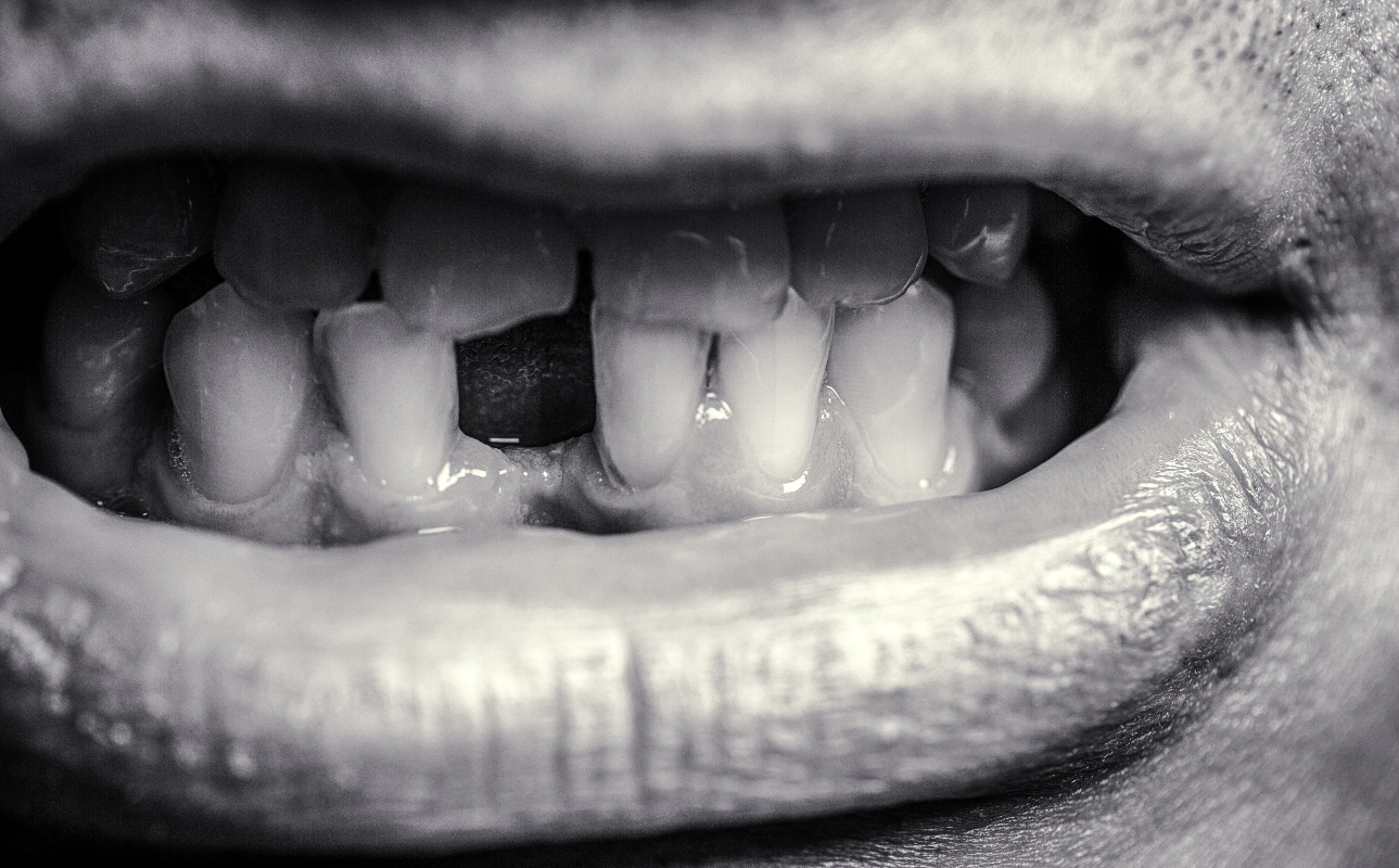 denti: malattie e infezioni dentali 