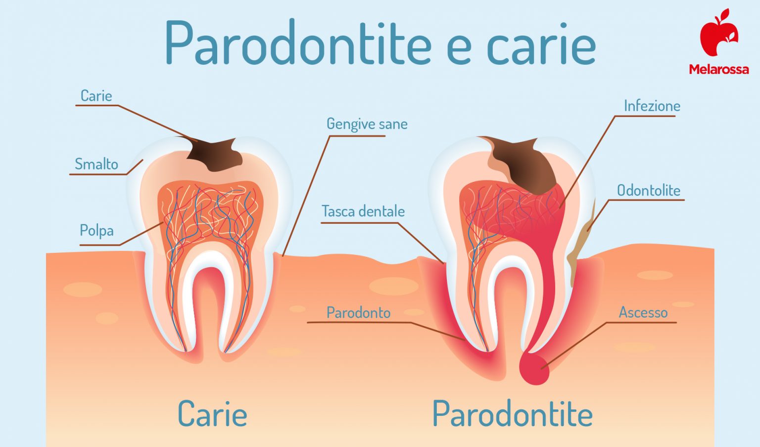 denti: paradontite 