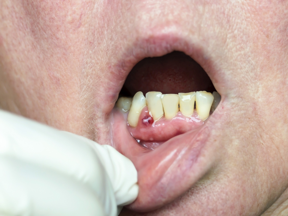 granuloma dentale: come si cura 