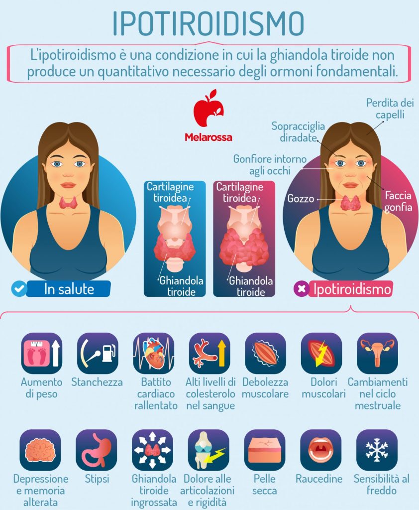 Ipotiroidismo cos’è, cause, sintomi, diagnosi, trattamento e dieta