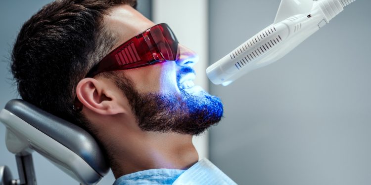 sbiancamento denti: cos'è, come funziona, tipologia, risultati, effetti collaterali