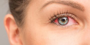 uveite: cos'è, cause, sintomi, cure