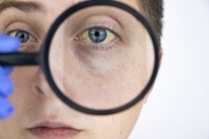 Anemia emolitica: che cos’è, quanti tipi esistono, come si manifesta,  cause, diagnosi e cure