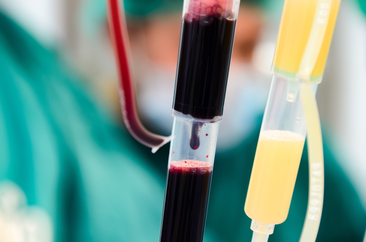 anemia emolitica: cure e trattamenti