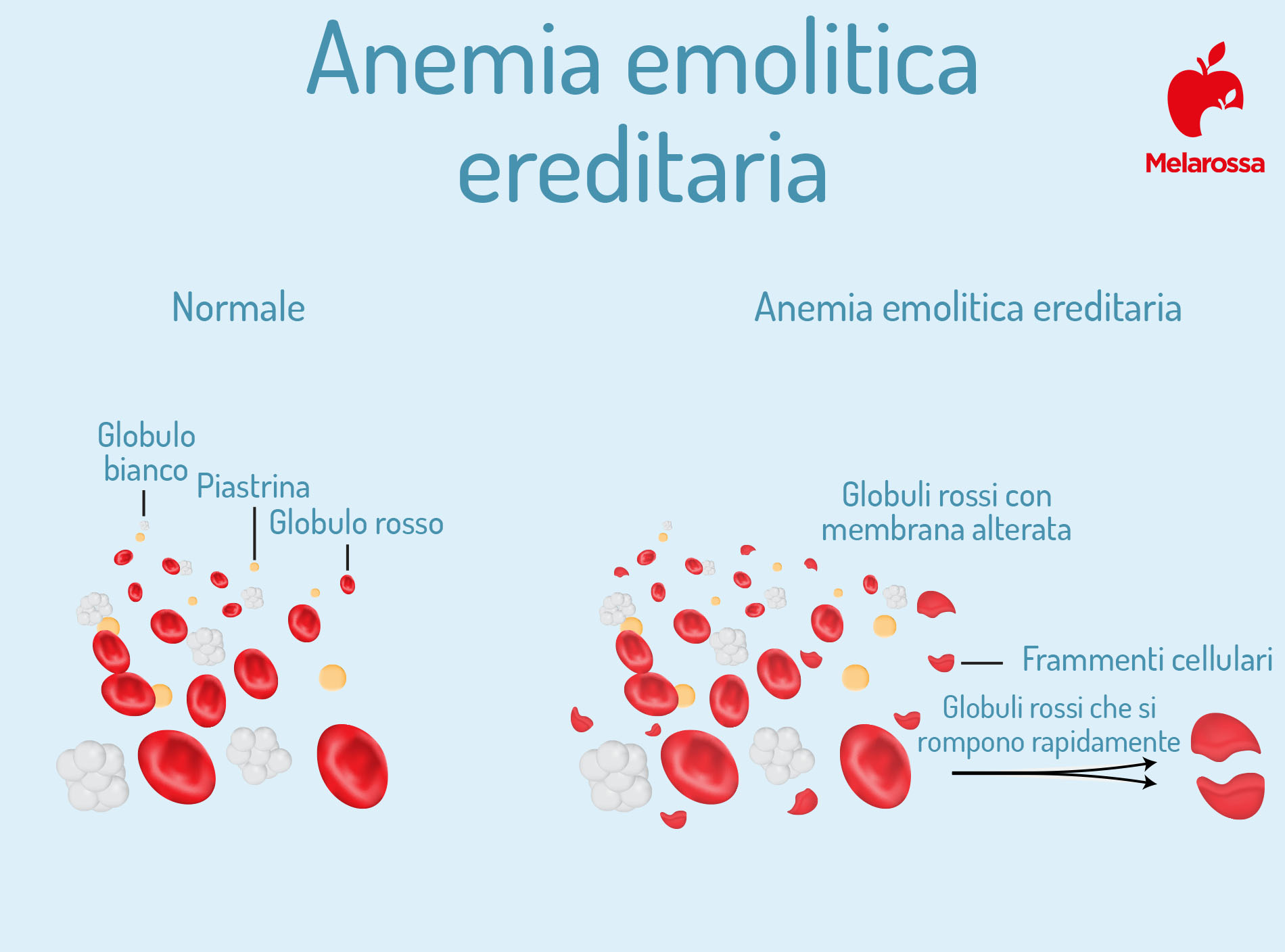 anemia emolitica ereditaria