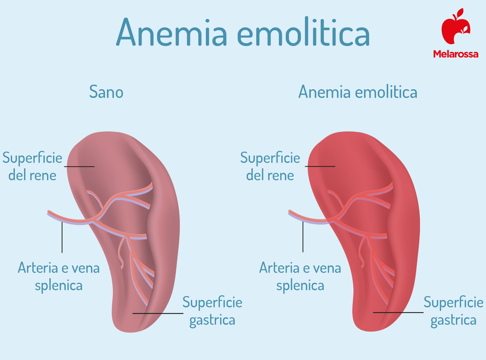 anemia emolitica 