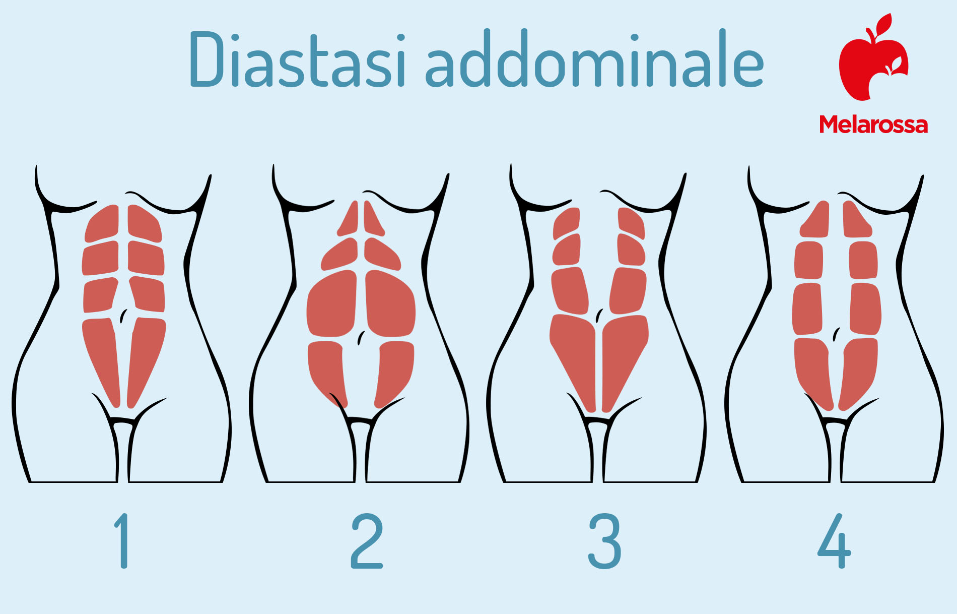 diastasi addominale: classificazione