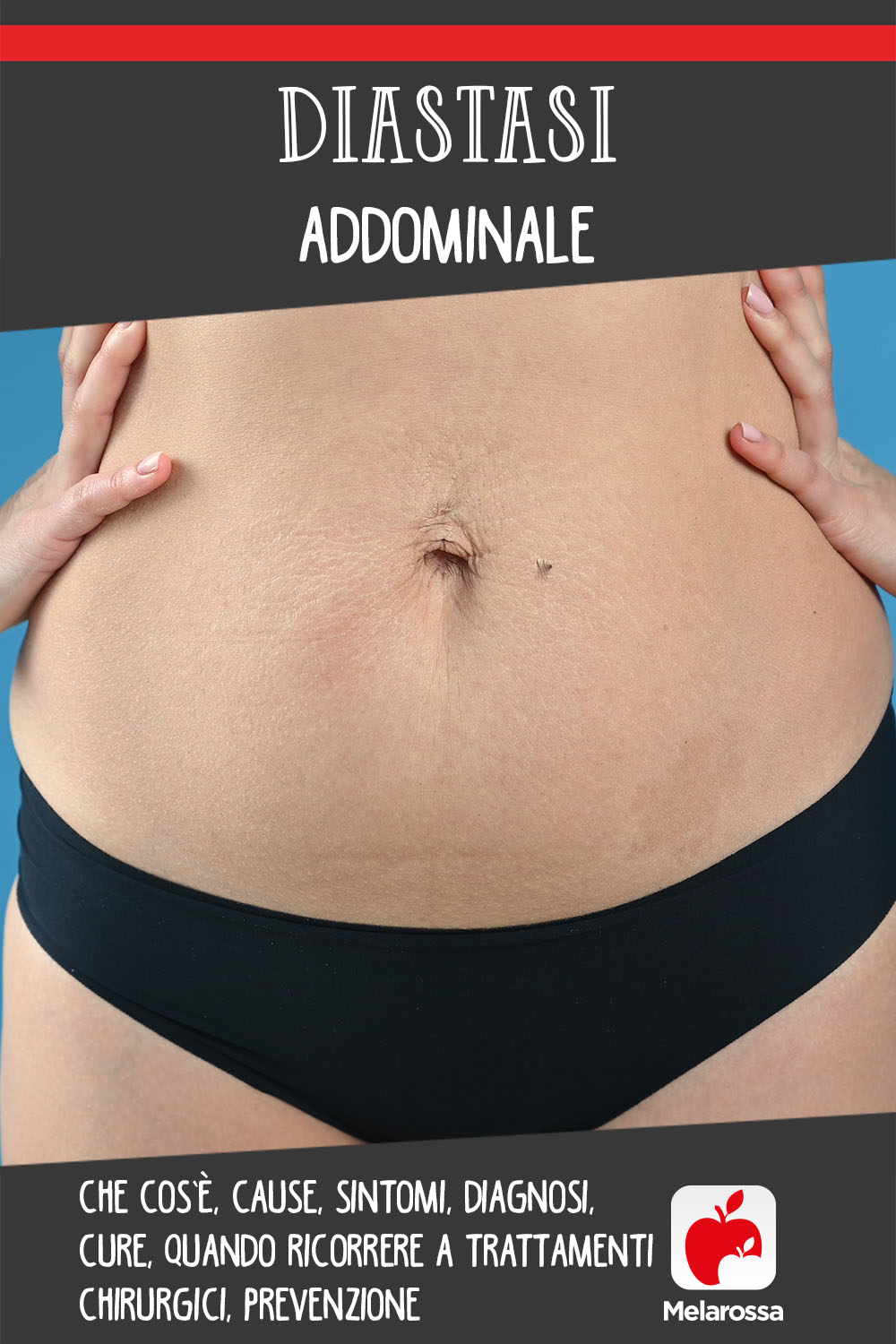 diastasi addominale: cos'è, cause, sintomi e cure