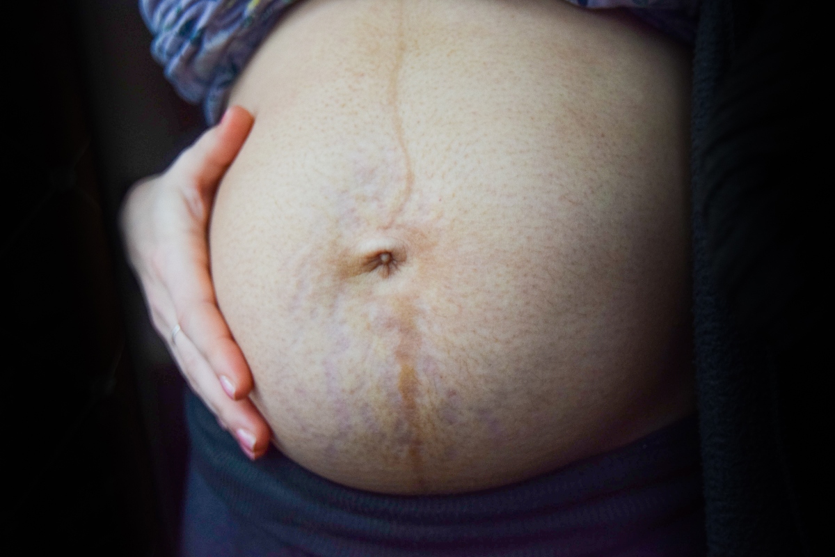 diastasi addominale: post gravidanza