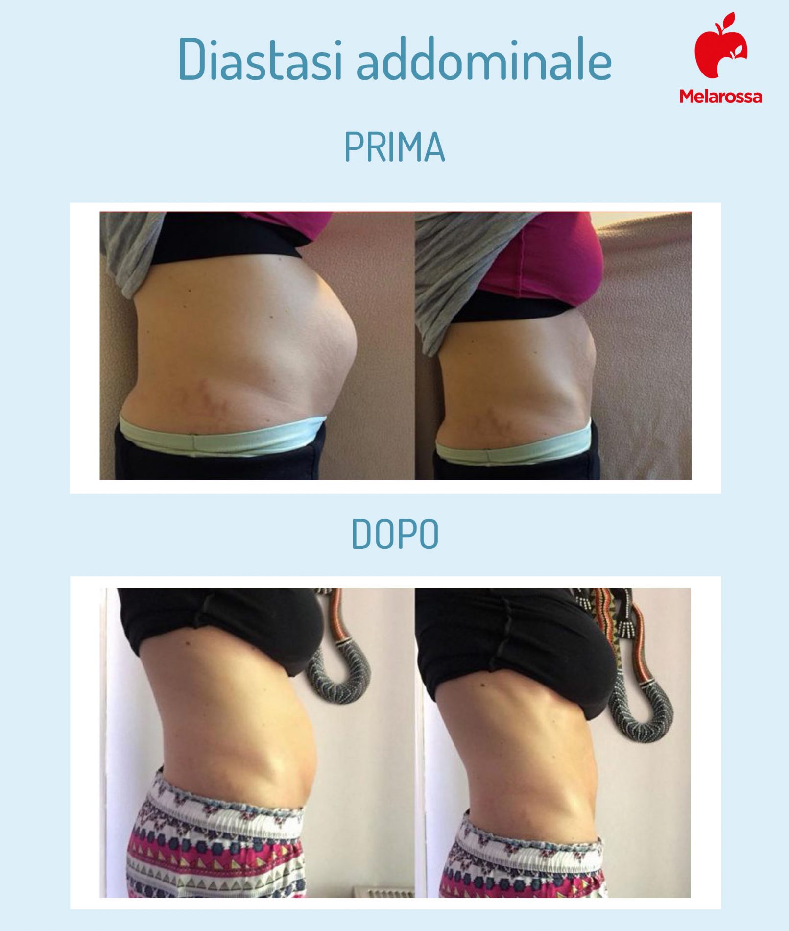 diastasi addominale: risultati dopo ginnastica ipopressiva