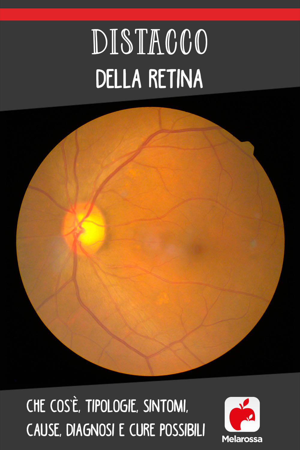 distacco della retina: cos'è, cause, sintomi e cure 