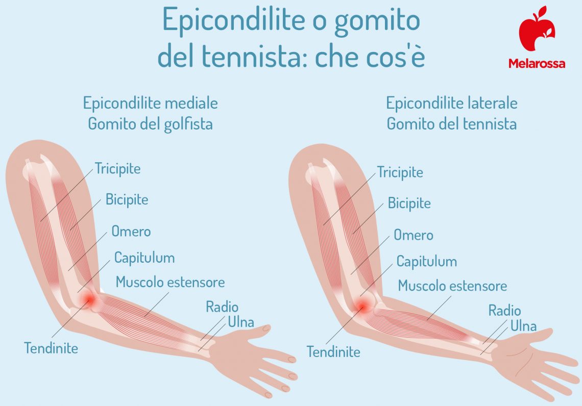 Epicondilite: cos’è, cause, sintomi, cura e rimedi