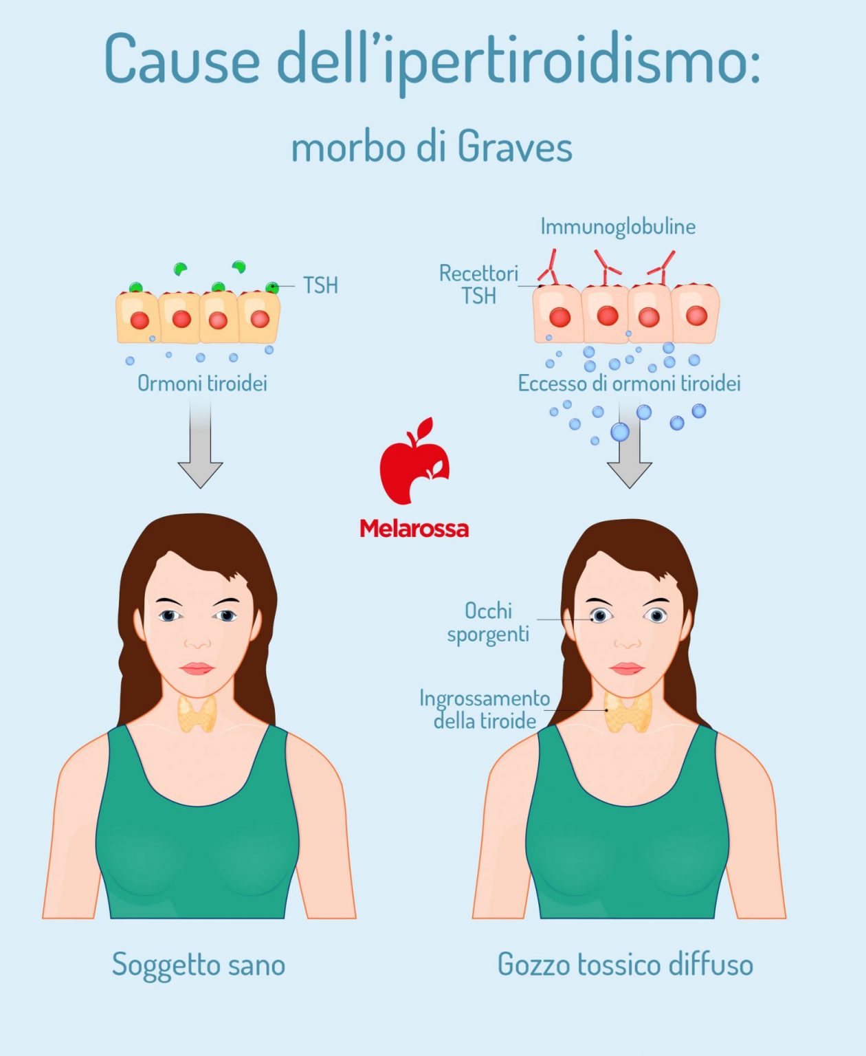 Ipertiroidismo cos'è, cause, sintomi, diagnosi, cure e dieta Melarossa Ipertiroidismo cos'è, cause, sintomi, diagnosi, cure e dieta Melarossa