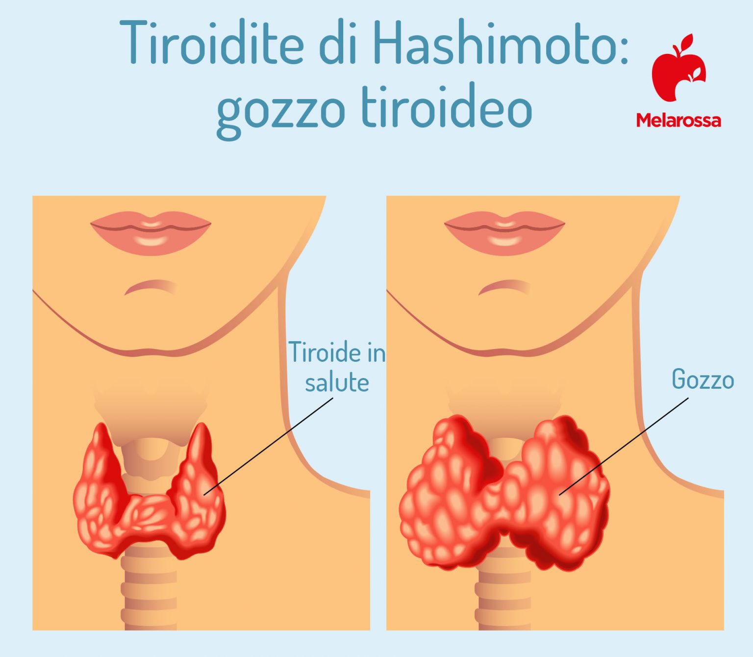 Tiroidite di Hashimoto che cos’è, sintomi, diagnosi e cure