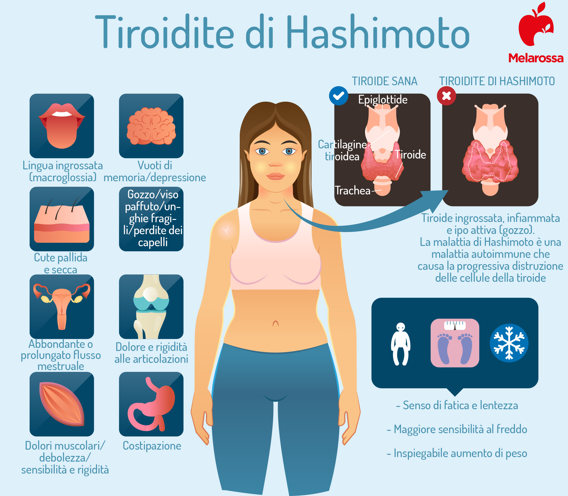tiroidite di Hashimoto: sintomi 