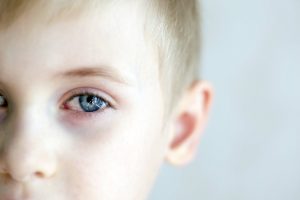 Cheratite oculare: cos’è, sintomi,  cause,  diagnosi, cure e prevenzione