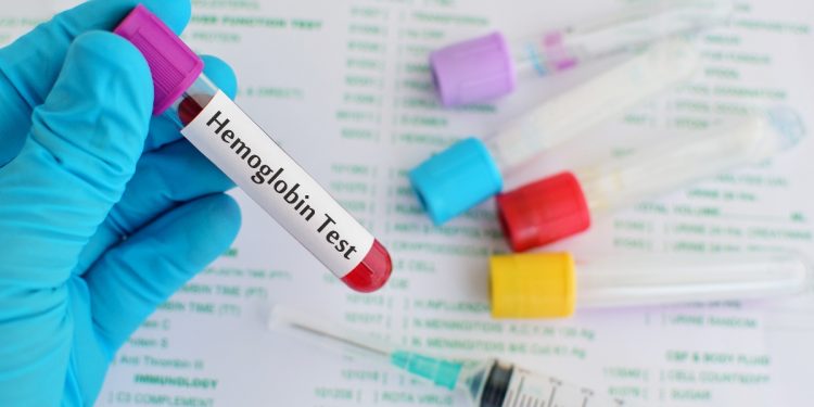 emoglobina: cos'è, quando fare il test, valori normali e cosa fare quando è alta o bassa