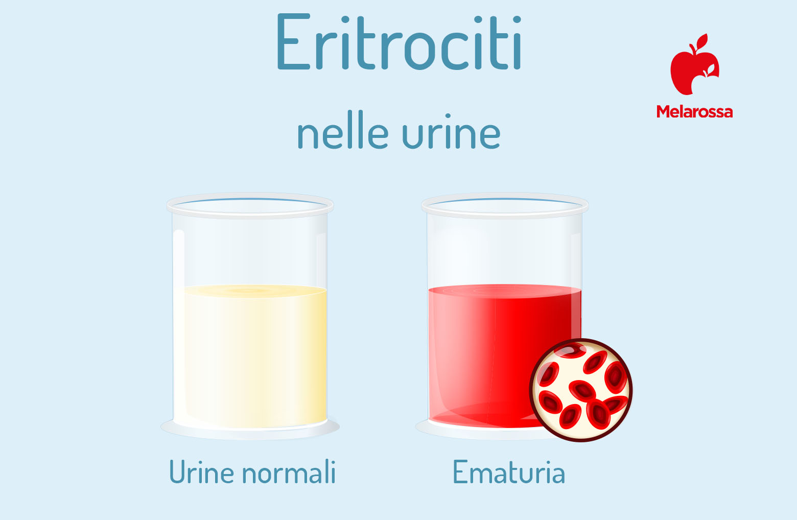 eritrociti nelle urine