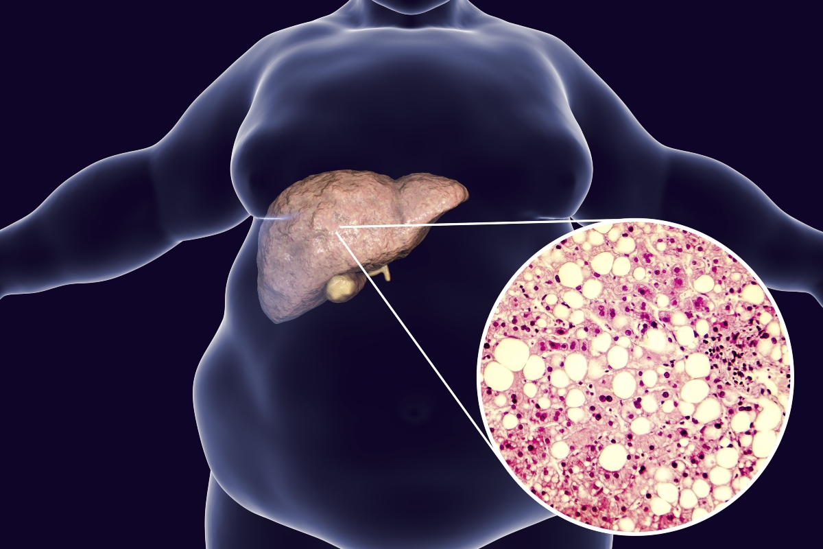 fegato grasso: cause e fattori di rischio