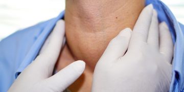 gozzo tiroideo: cos'è, cause, sintomi e cure