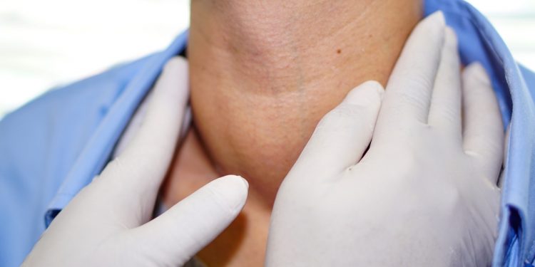 gozzo tiroideo: cos'è, cause, sintomi e cure
