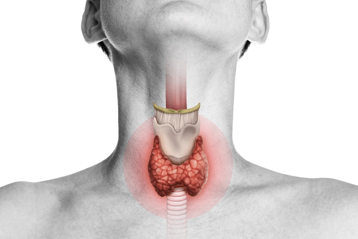 gozzo tiroideo