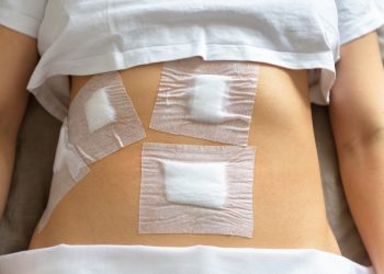 Una donna con dei cerotti sulla pancia dopo aver subito una laparoscopia