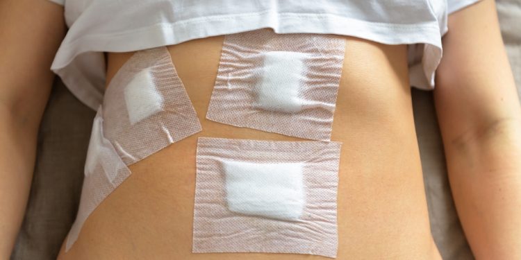 Una donna con dei cerotti sulla pancia dopo aver subito una laparoscopia