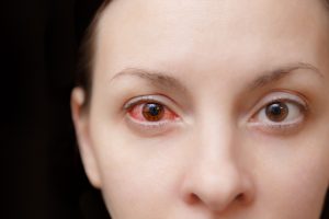 Sangue nell’occhio: cos’è, sintomi, cause, cosa fare e quando preoccuparsi