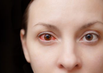 sangue nell'occhio: cos'è, cause, sintomi e cure
