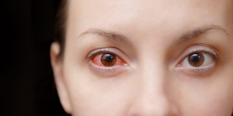 sangue nell'occhio: cos'è, cause, sintomi e cure