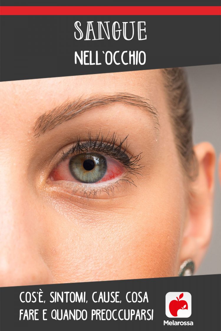 Sangue Nell occhio Cos Sintomi Cause Cosa Fare Quando Preoccuparsi sangue-nell-occhio-cos-sintomi-cause-cosa-fare-quando-preoccuparsi