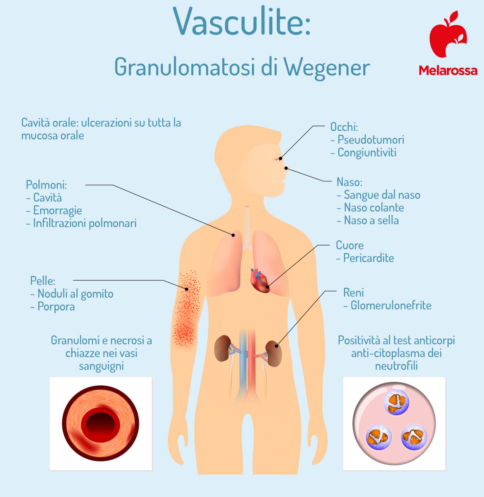vasculite: granulomatosi di Wegener