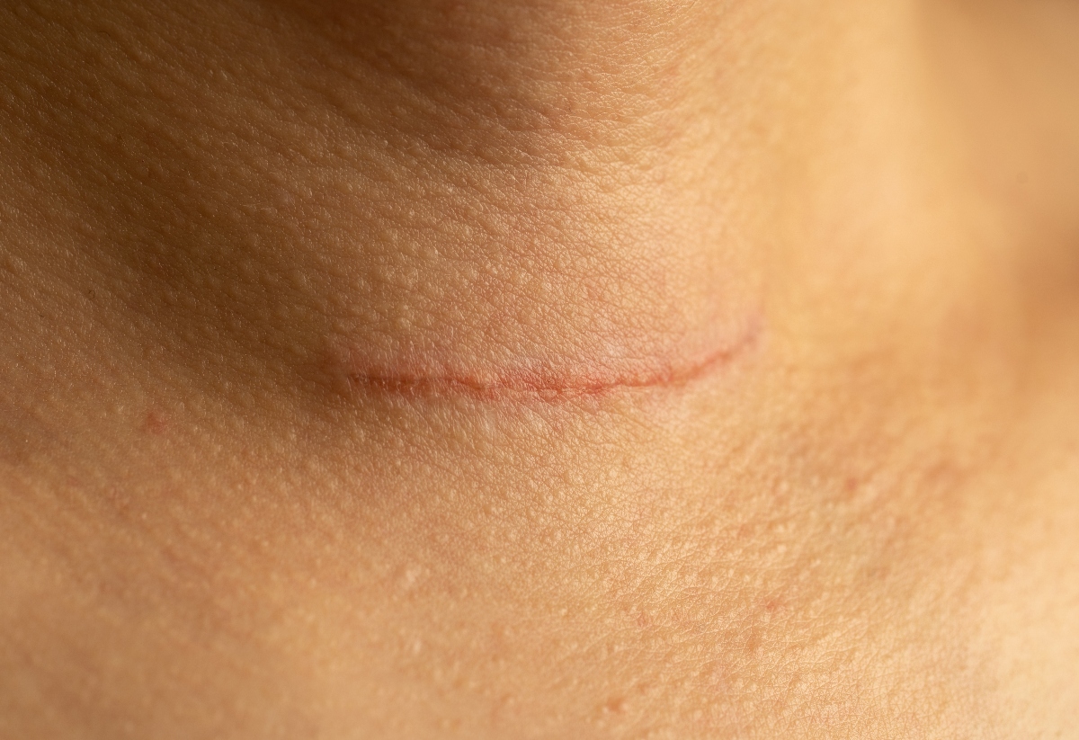 disturbi alla tiroide: cure