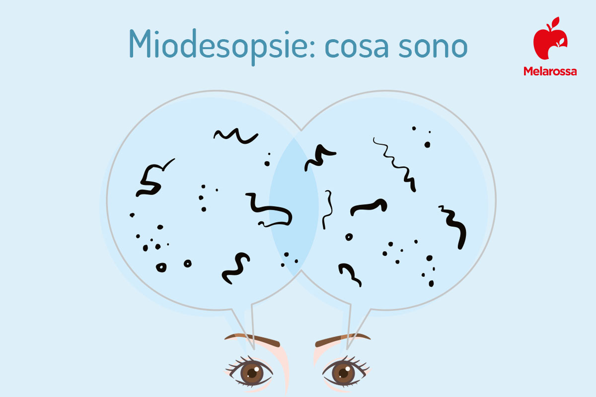  disturbi oculari: miodesopsie 