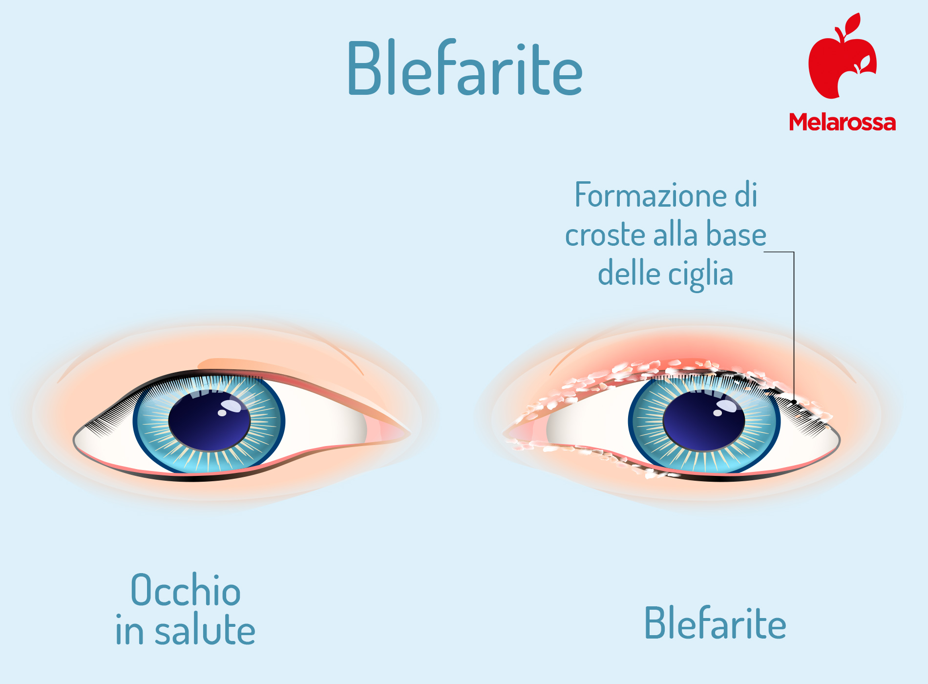 malattia  dell'occhio: blefarite 