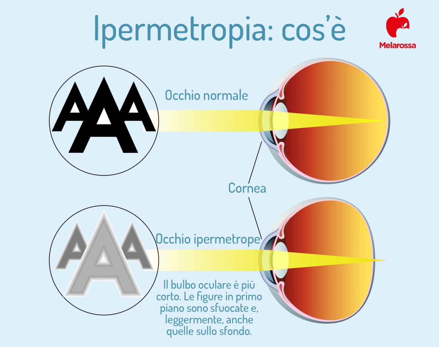 malattie dell'occhio: ipermetropia