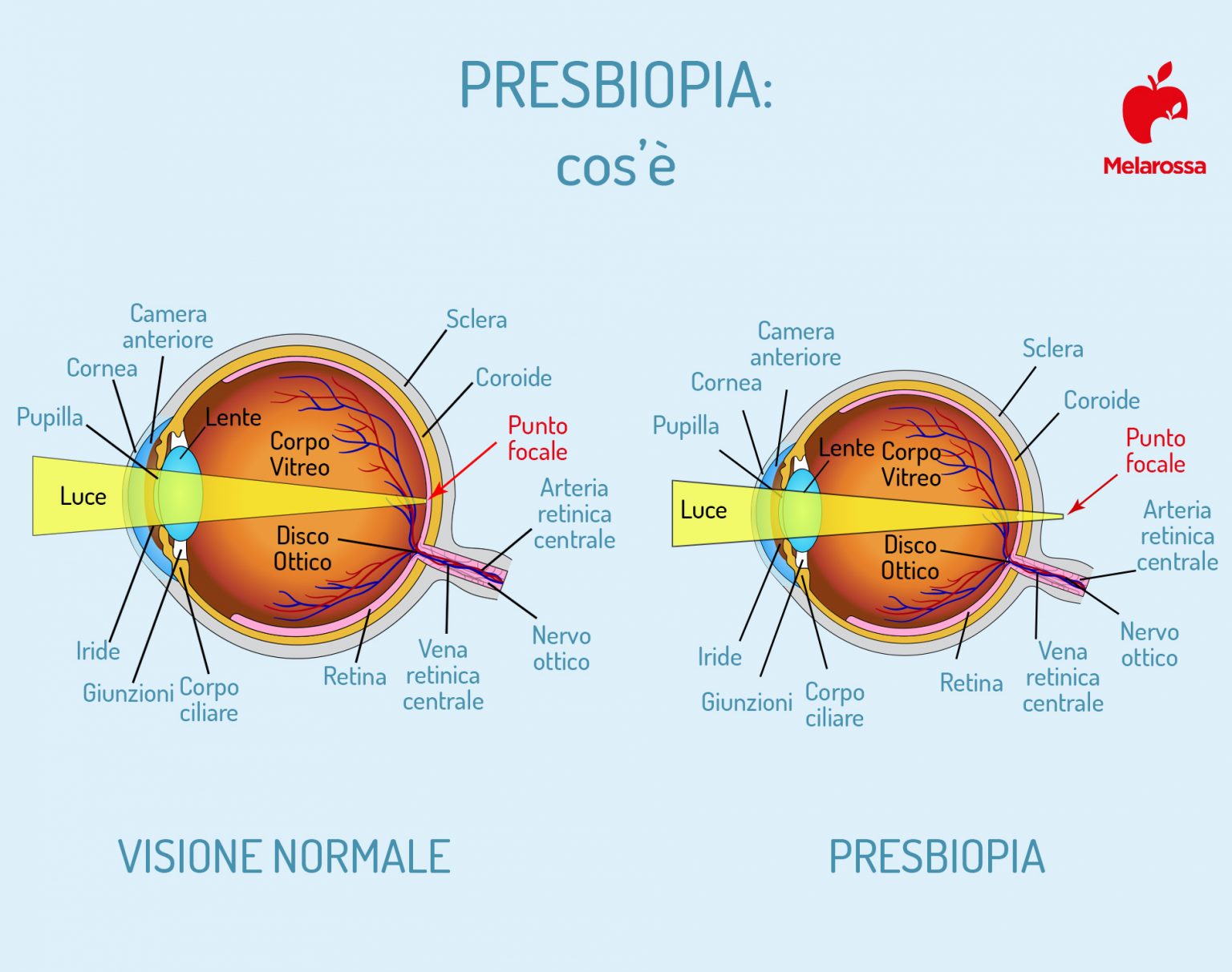 malattie dell'occhio: presbiopia 