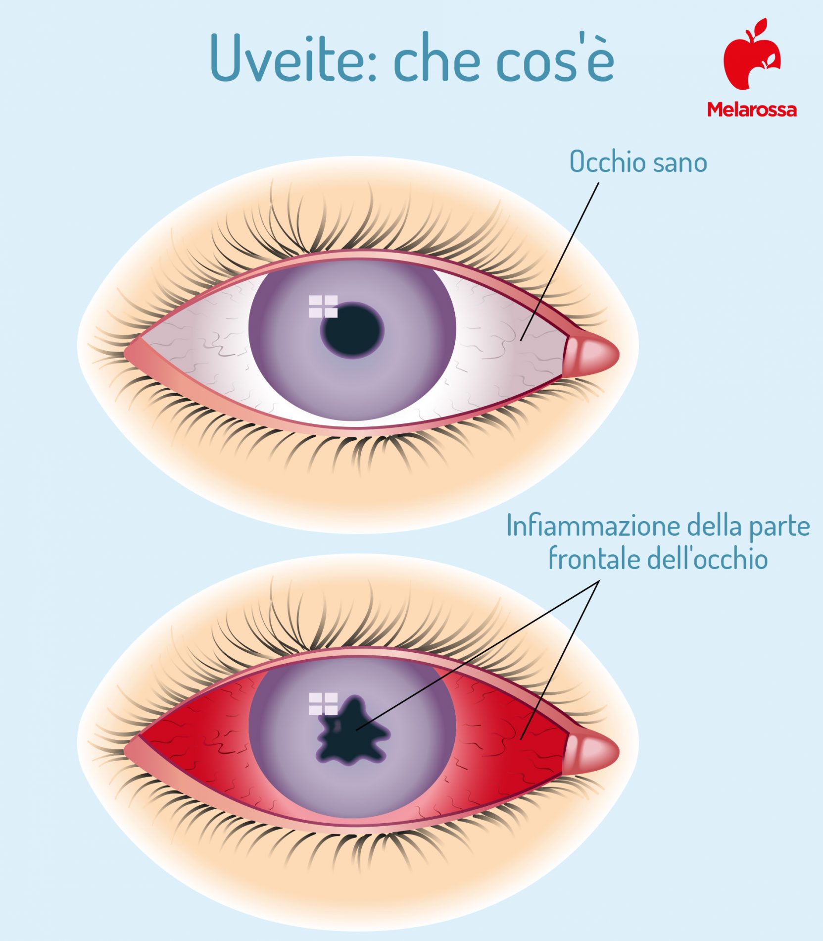 malattie dell'occhio: uveite 