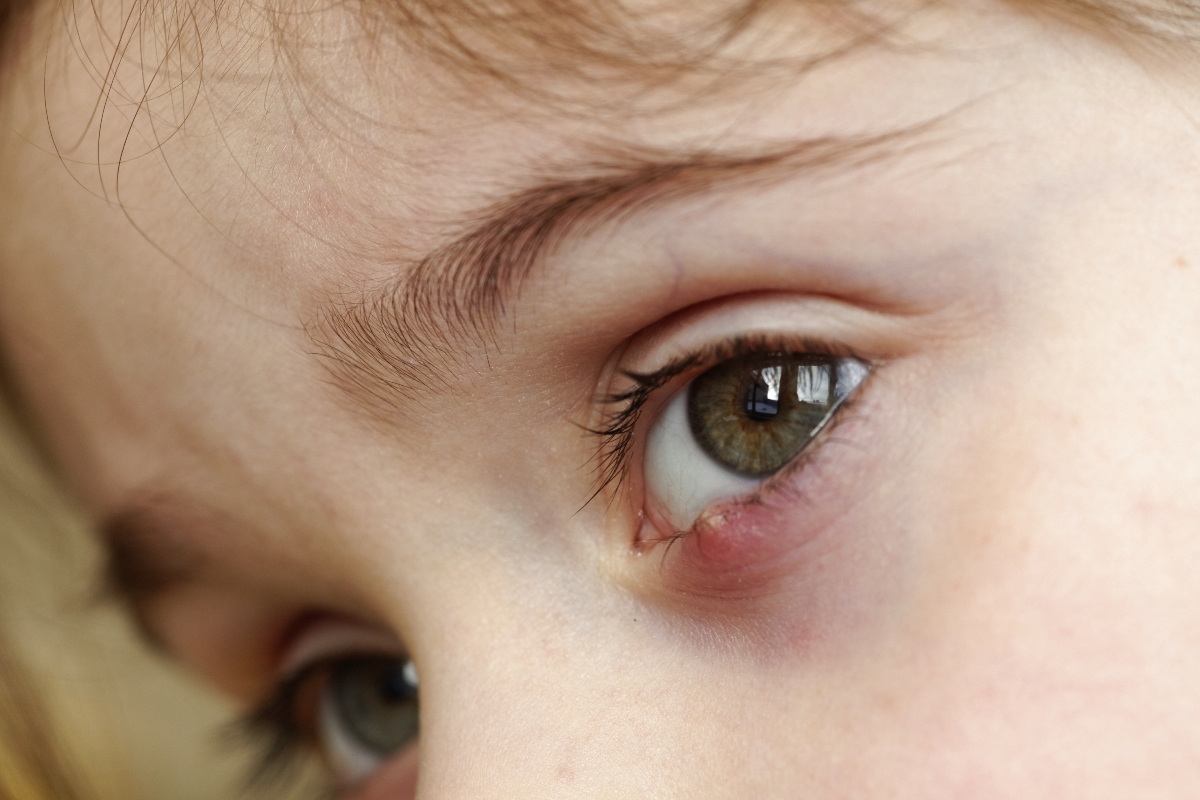 orzaiolo: infezione dell'occhio 