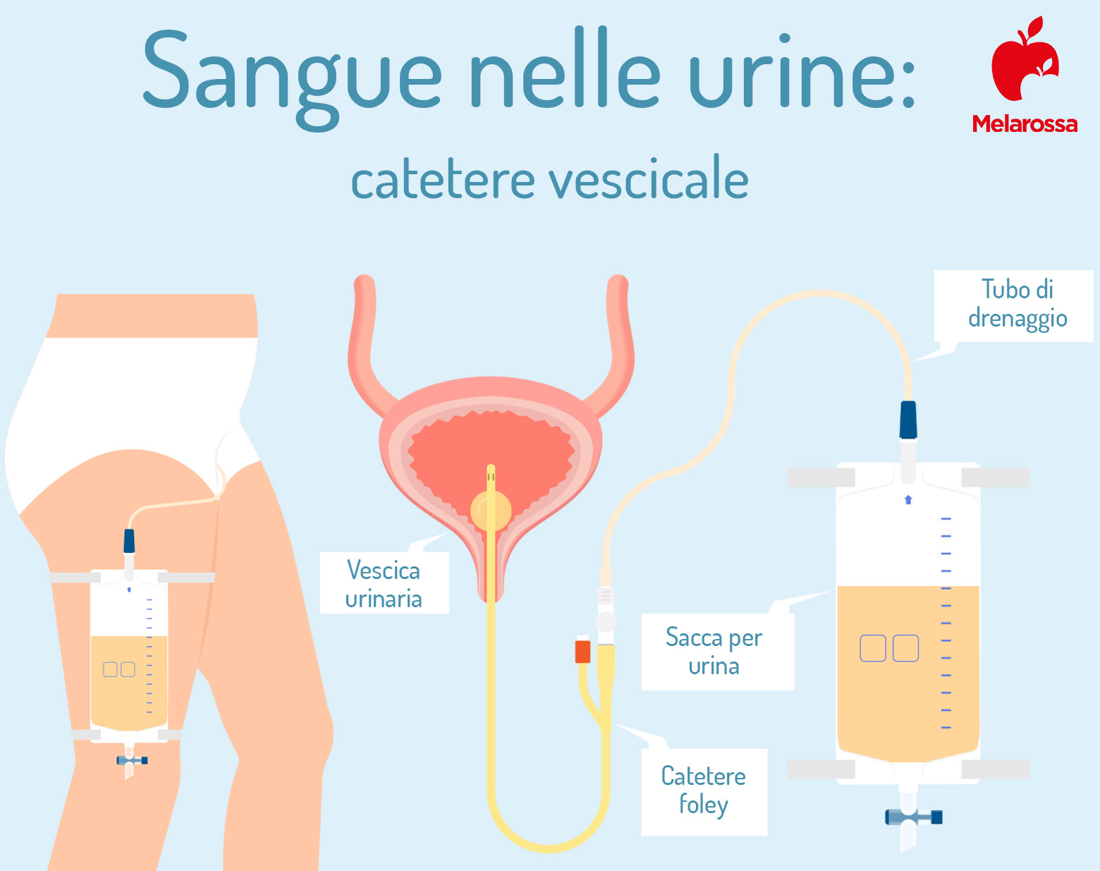 sangue nelle urine: catetere vescicale 